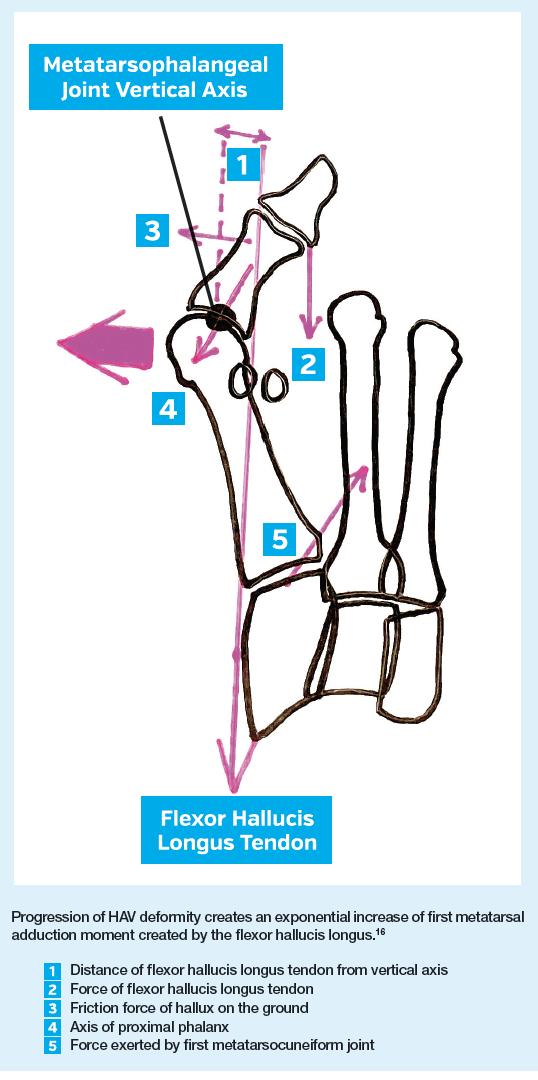 Hallux Valgus Biomechanics